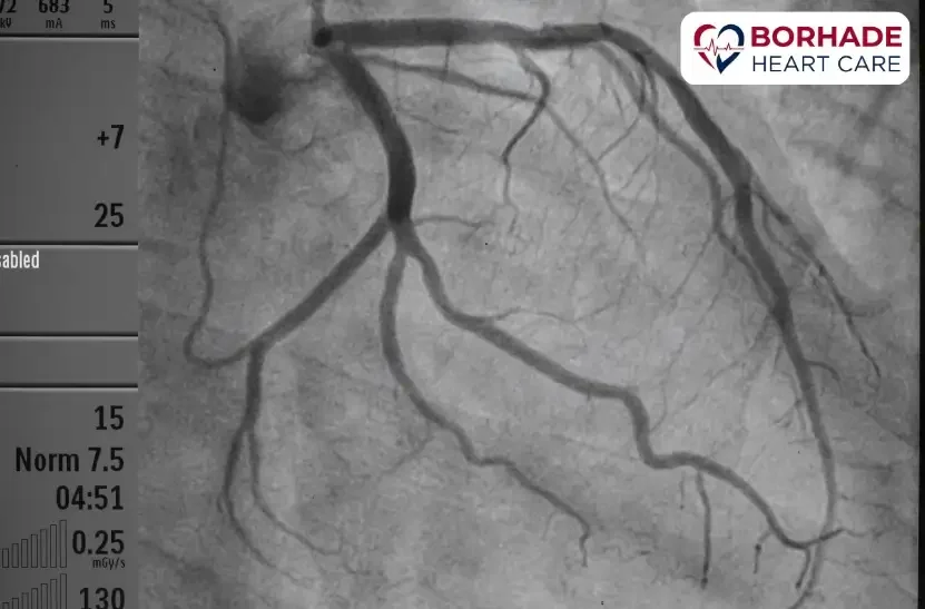 Angiography in Pune by Dr. Ajinkya Borhade