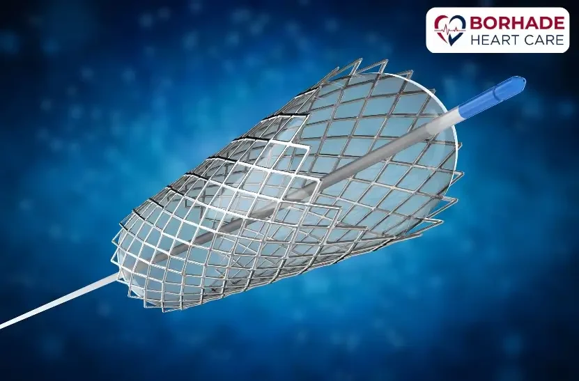 Angioplasty in Pune by Dr. Ajinkya Borhade