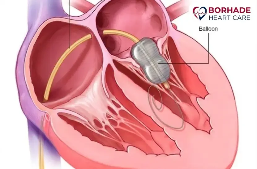 Balloon Valvuloplasty in Pune by Dr. Ajinkya Borhade