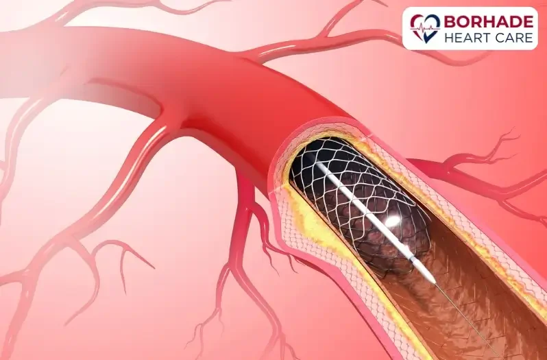 Demonstration of metal stent in artery.