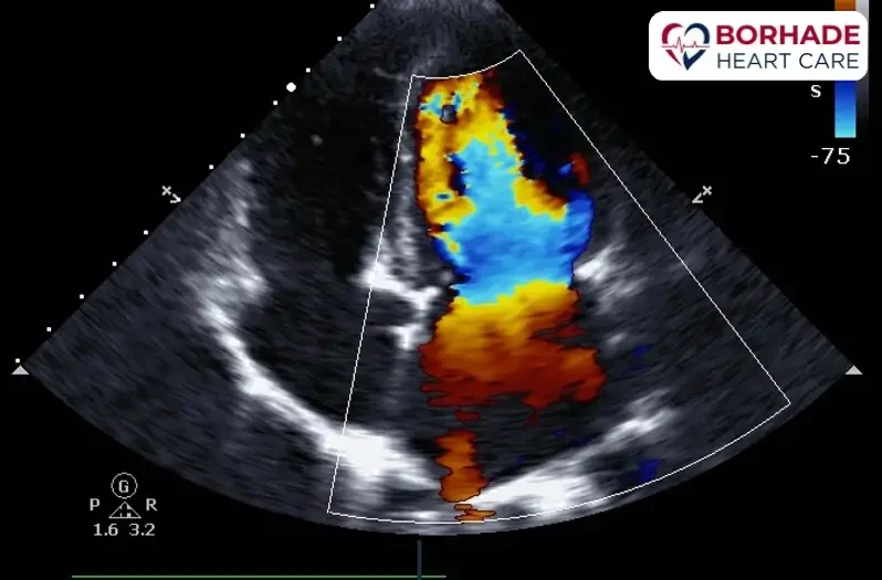 Visuals of Color Doppler Echocardiography.