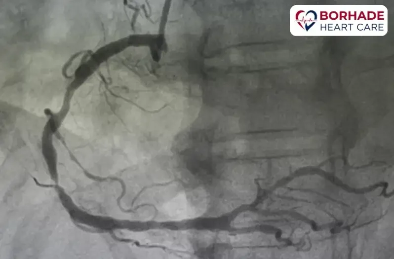 Coronary angiography in Pune by Dr. Ajinkya Borhade