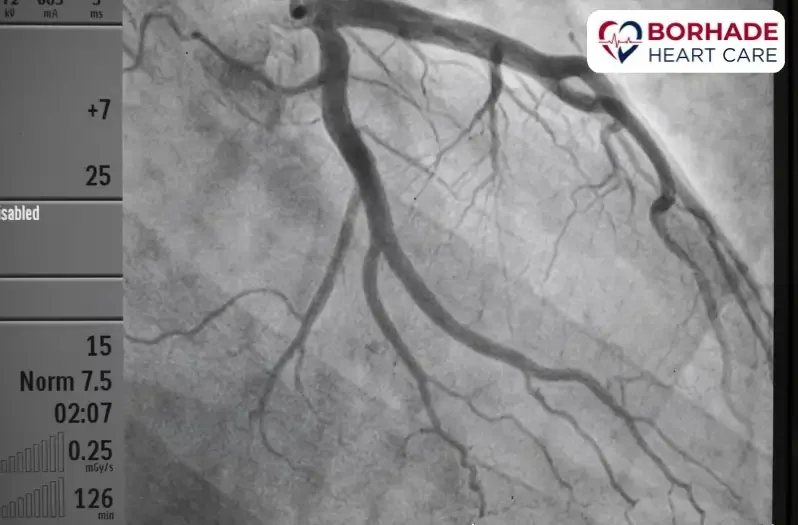 Angiogram view of coronary artery.