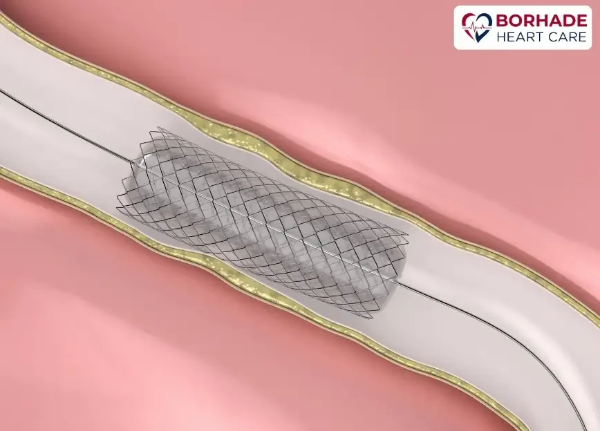 a catheter with stent in artery.